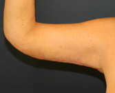 Feel Beautiful - Arm Lift San Diego 27 - After Photo